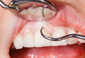 tratamento-dentista-priodontal